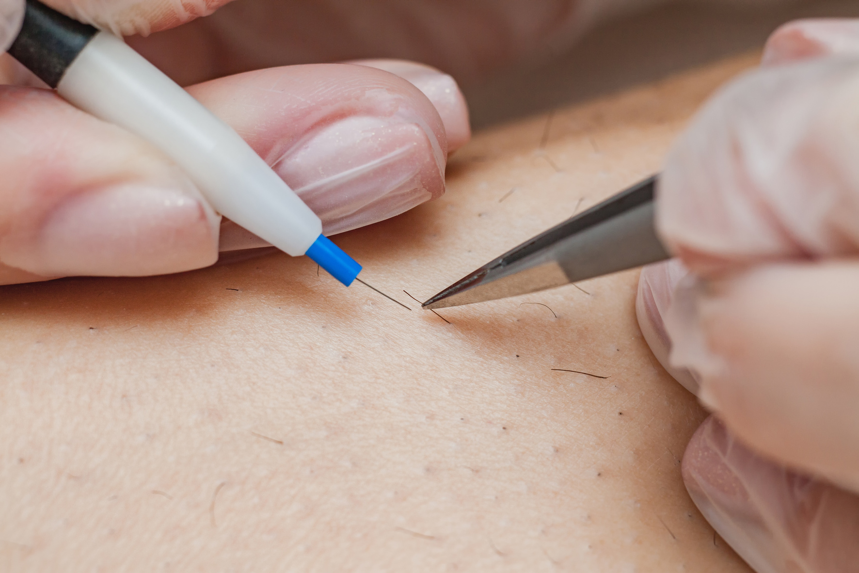 The Process of Permanent Unwanted Hair Removal, Using an Electroepilation Device and Tweezers